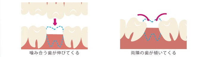 噛み合う歯が伸びてくる・両隣の歯が傾いてくる