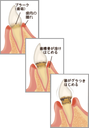 歯周病に至るまで